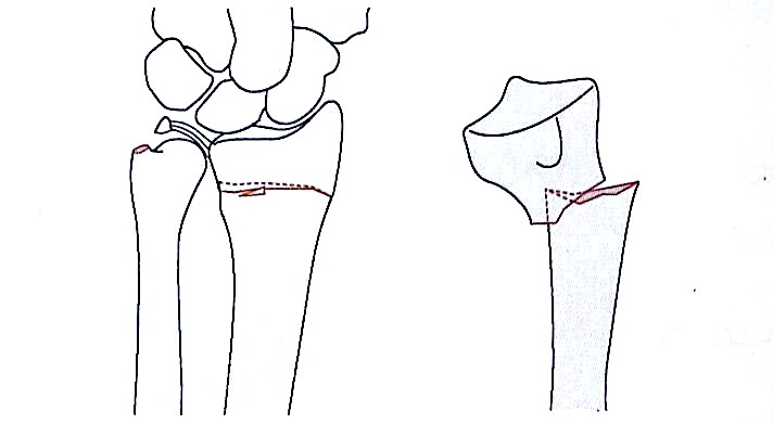 Дистальный радиус переломы-3