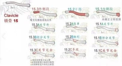 Диагноз и лечение перелома ключицы-10