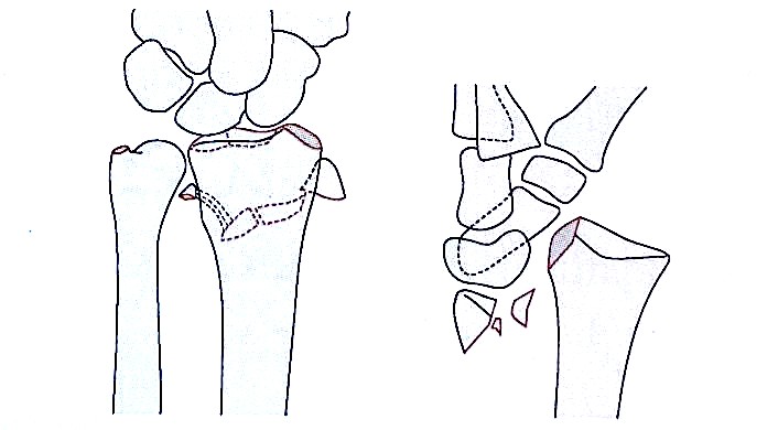 Дистальный радиус переломы-6