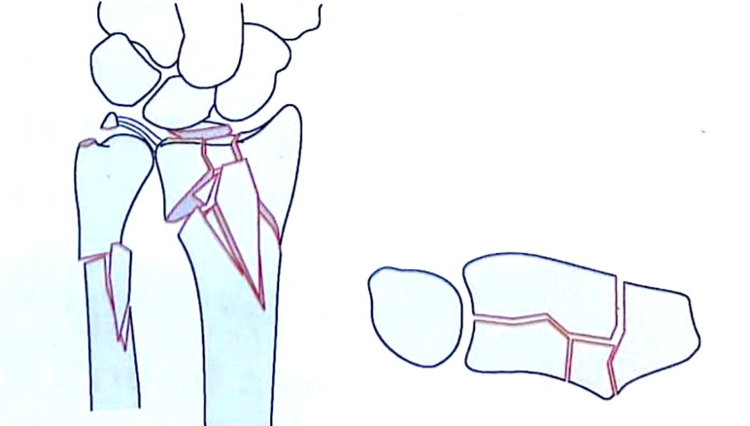Дистальный радиус переломы-7