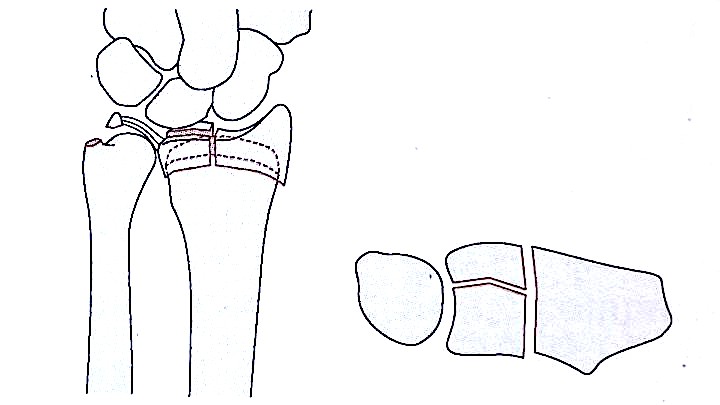 Дистальный радиус переломы-5